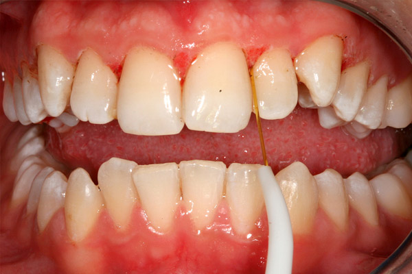 edematous gingiva